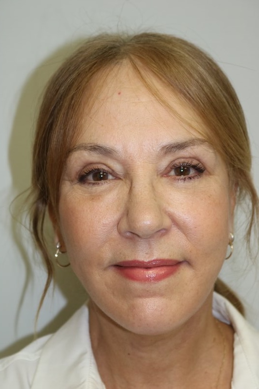 Neck Lift Before & After