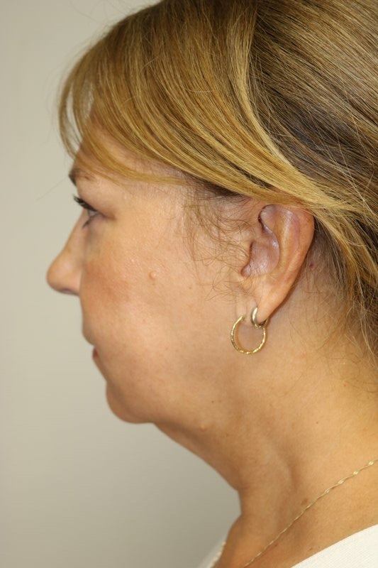 Neck Lift Before & After
