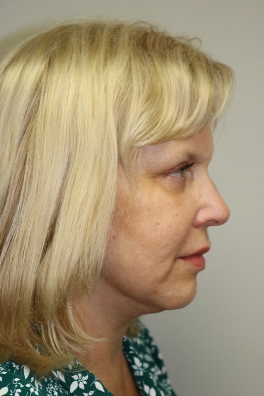 Neck Lift Before & After