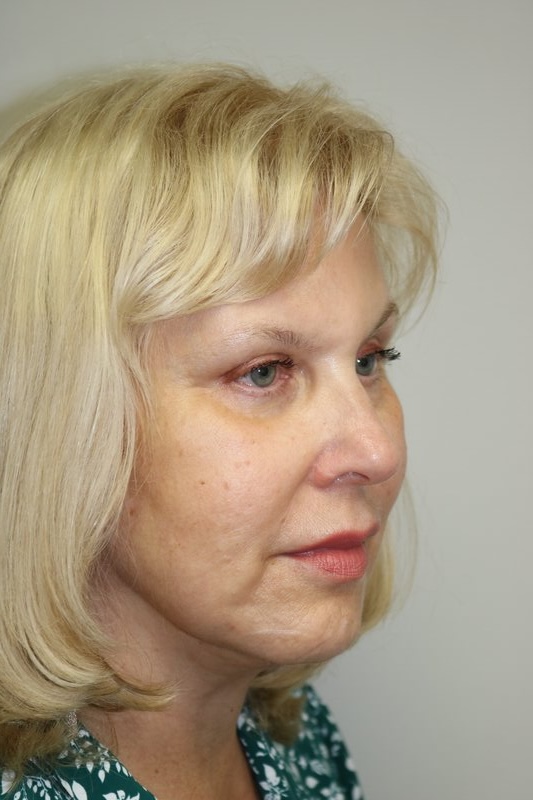 Neck Lift Before & After