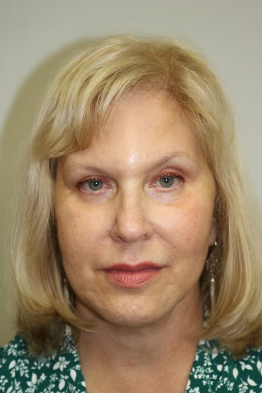 Neck Lift Before & After