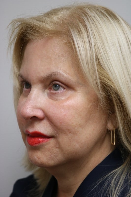 Neck Lift Before & After