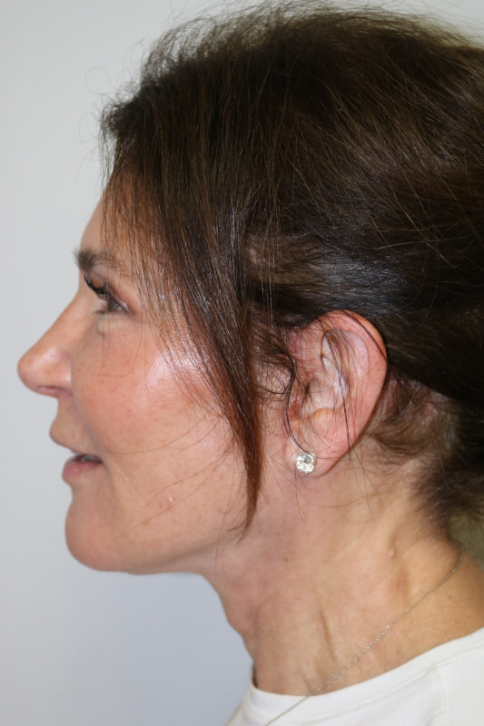 Neck Lift Before & After