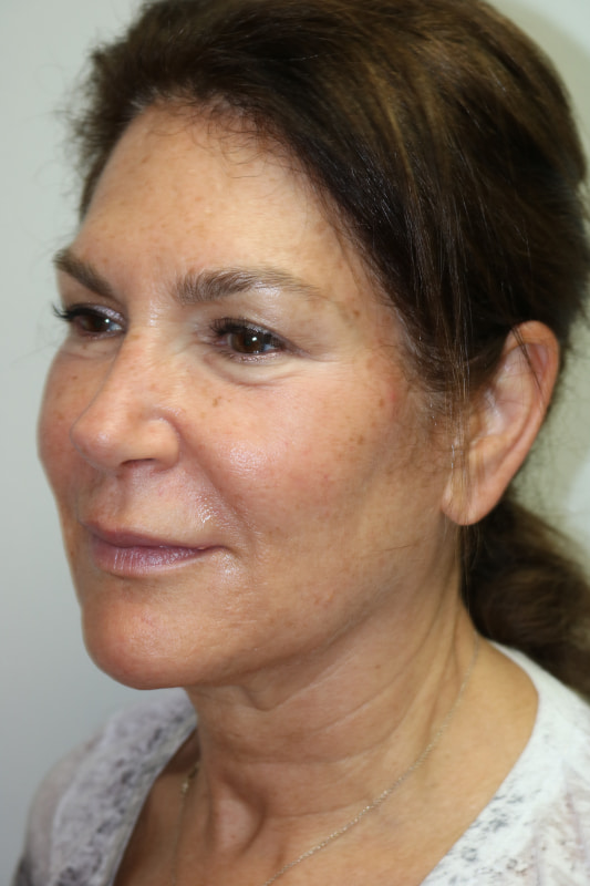 Neck Lift Before & After