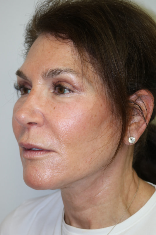 Neck Lift Before & After