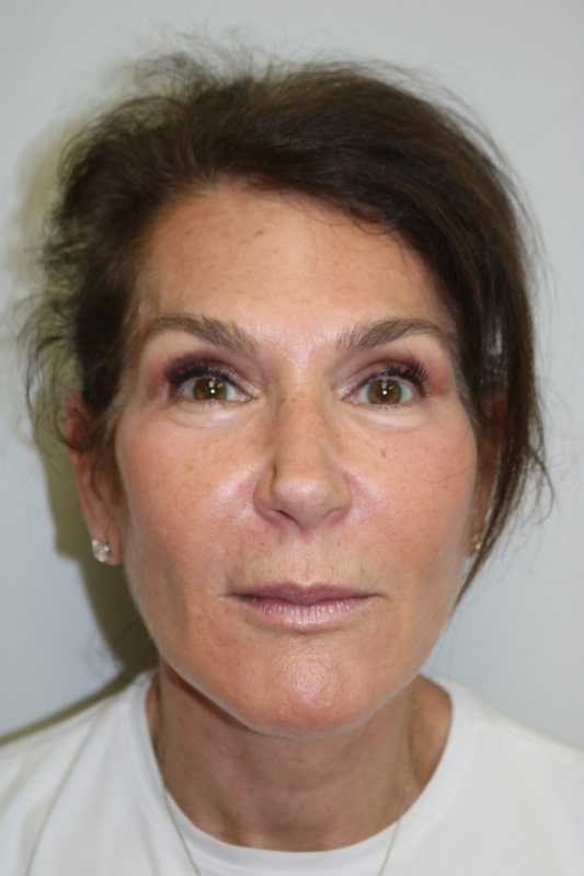 Neck Lift Before & After