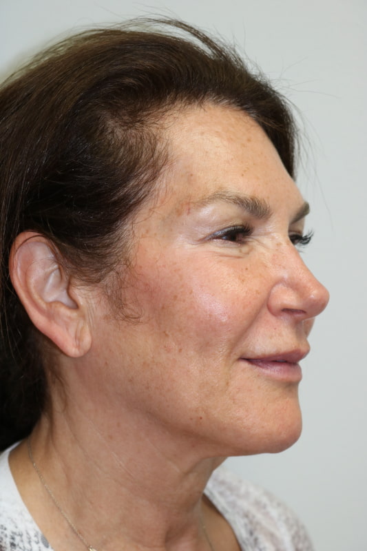 Neck Lift Before & After