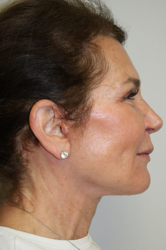 Neck Lift Before & After