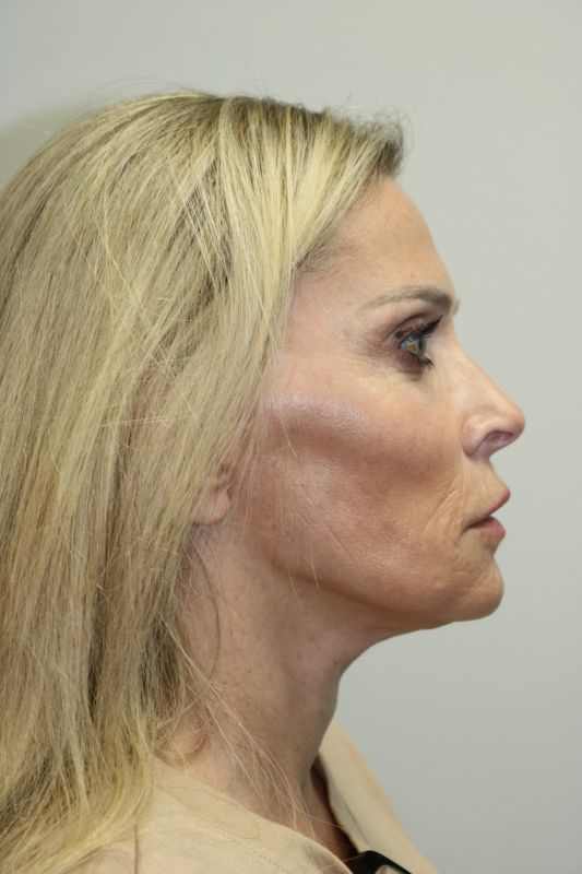 Neck Lift Before & After