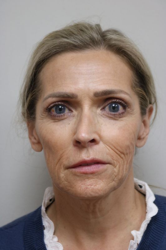 Neck Lift Before & After