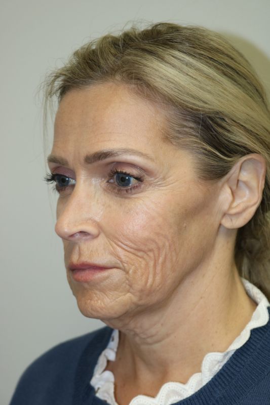 Neck Lift Before & After