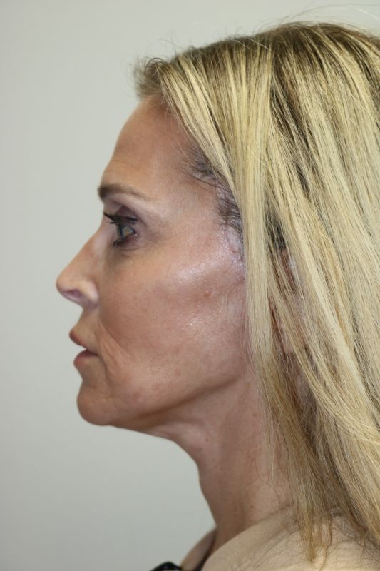 Neck Lift Before & After