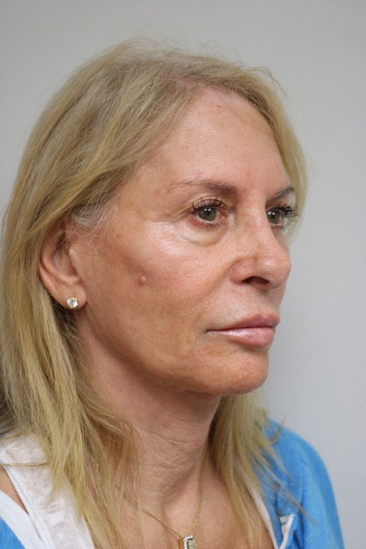 Neck Lift Before & After