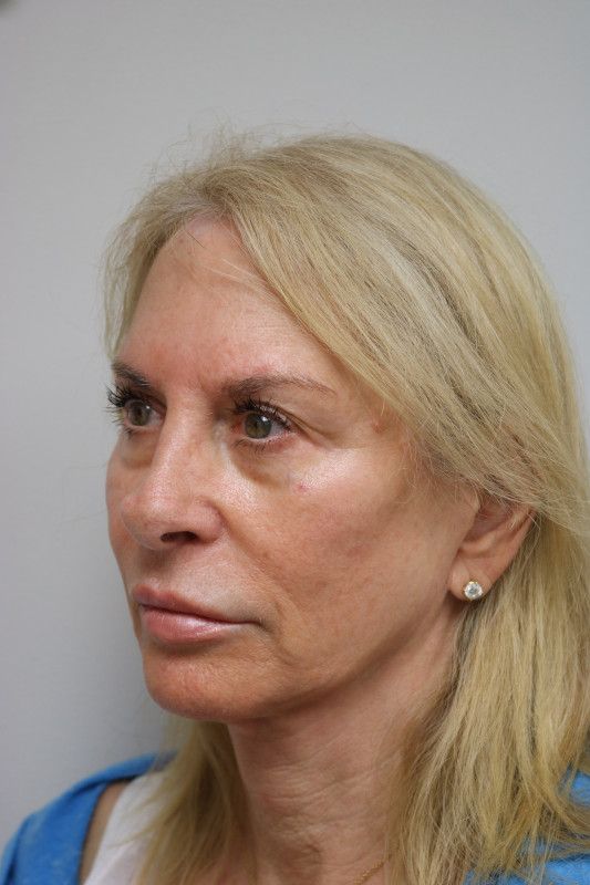 Neck Lift Before & After