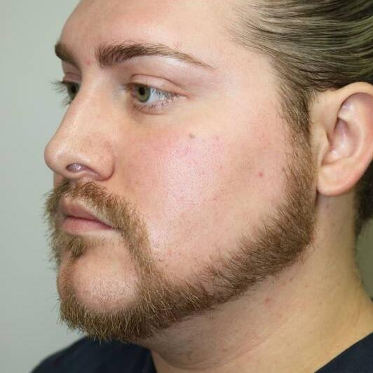 Neck Liposuction Before & After
