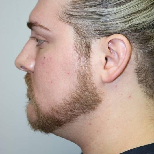 Neck Liposuction Before & After