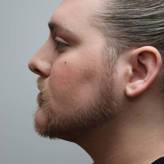 Neck Liposuction Before & After