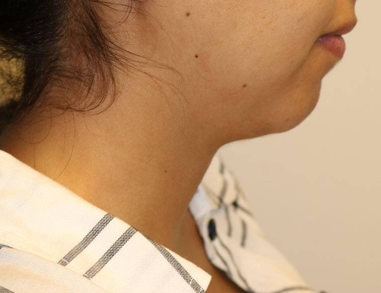 Neck Liposuction Before & After Image