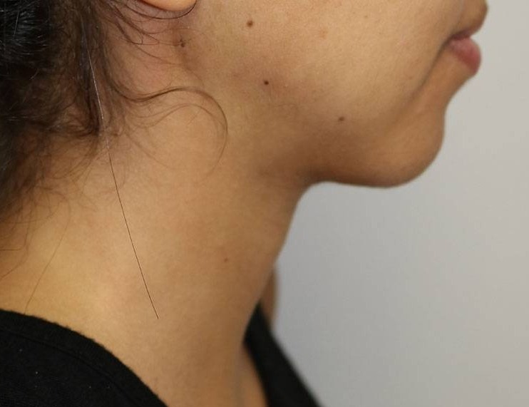 Neck Liposuction Before & After Image