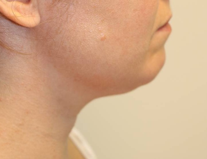 Neck Liposuction Before & After Image