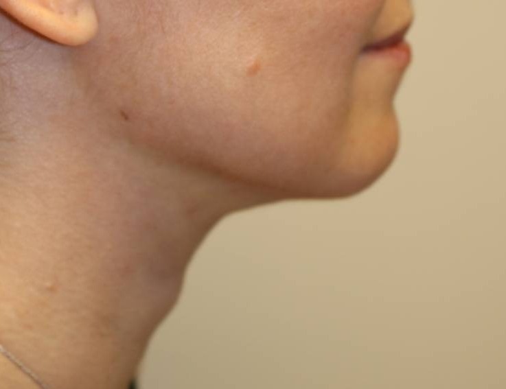 Neck Liposuction Before & After Image