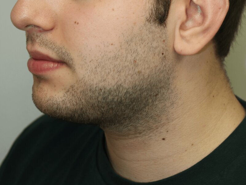 Neck Liposuction Before & After Image