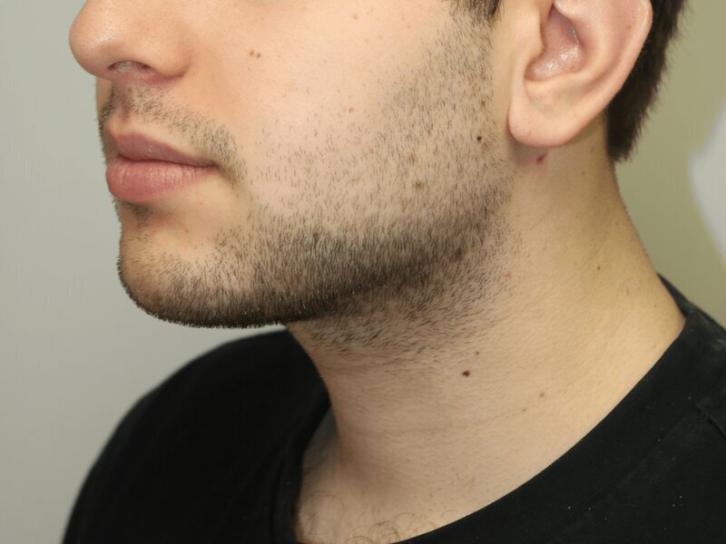 Neck Liposuction Before & After Image