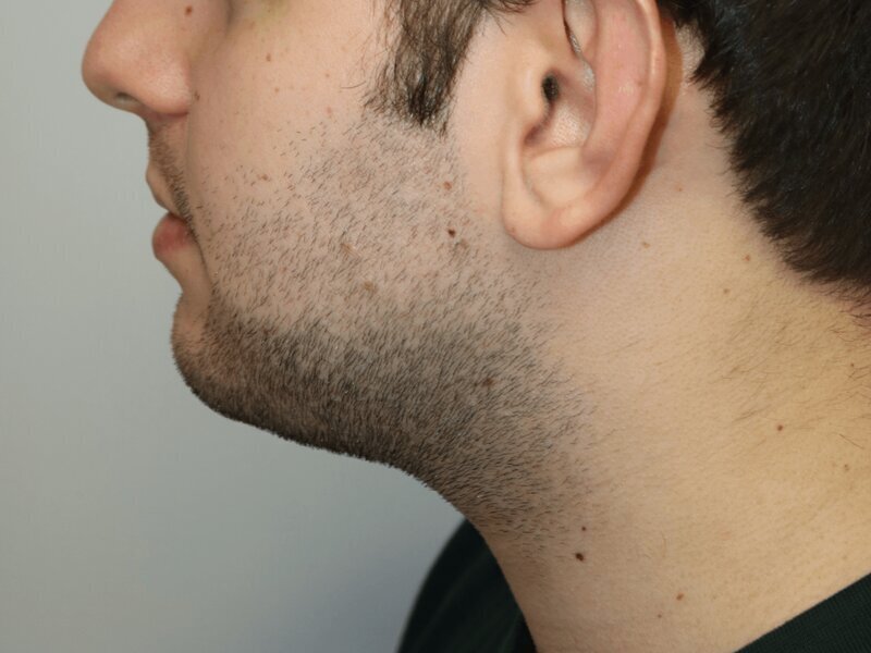 Neck Liposuction Before & After Image