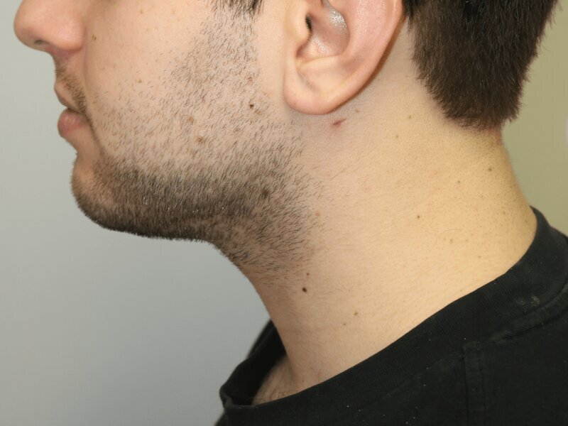 Neck Liposuction Before & After Image