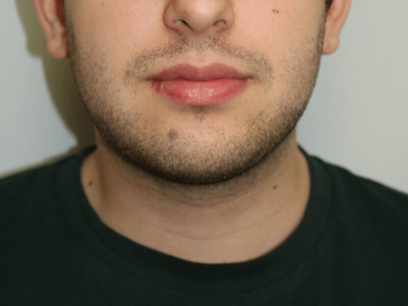 Neck Liposuction Before & After Image