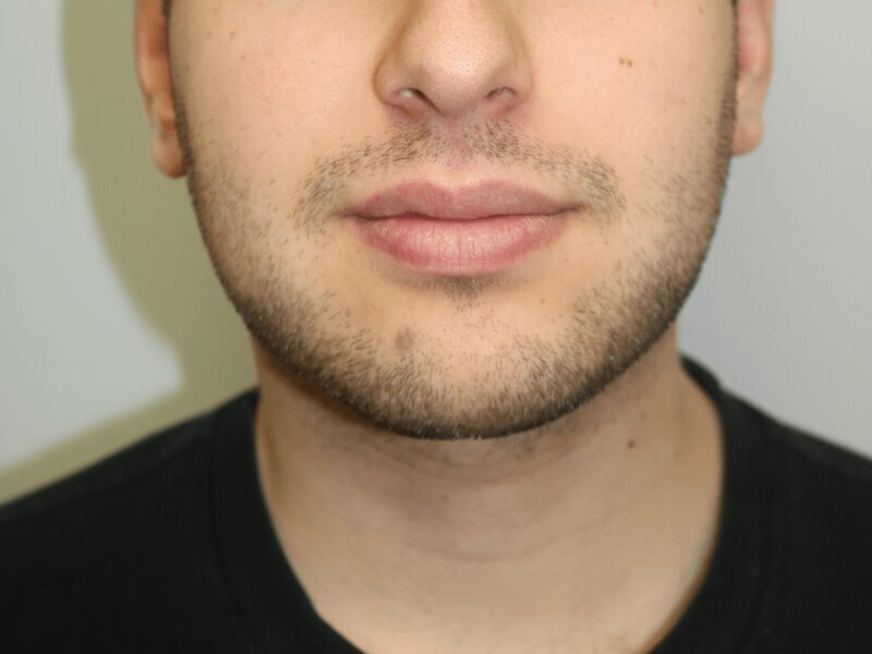 Neck Liposuction Before & After Image