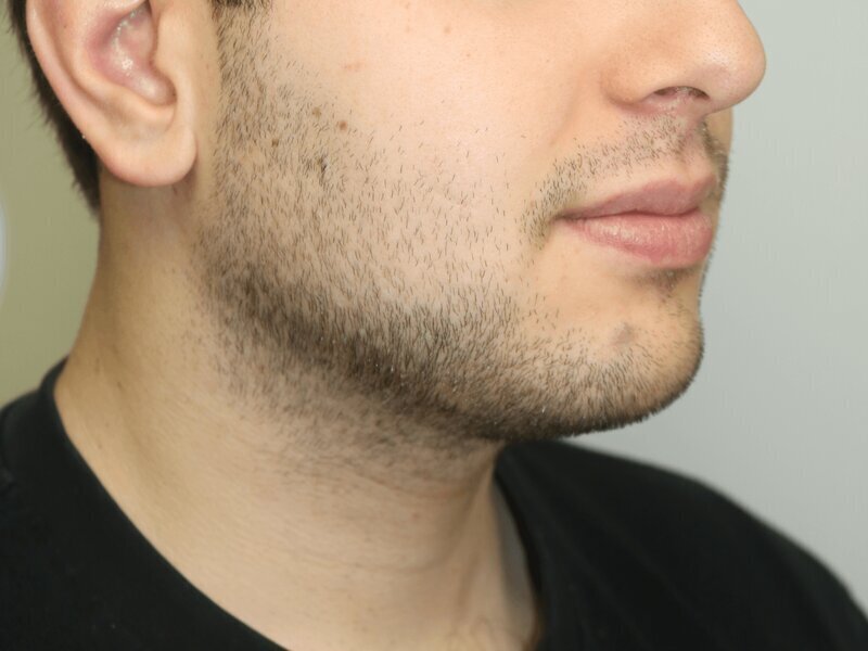 Neck Liposuction Before & After Image