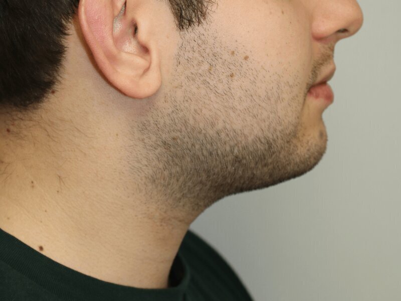 Neck Liposuction Before & After Image
