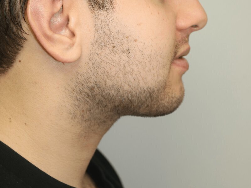 Neck Liposuction Before & After Image