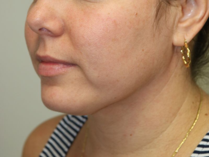 Neck Liposuction Before & After