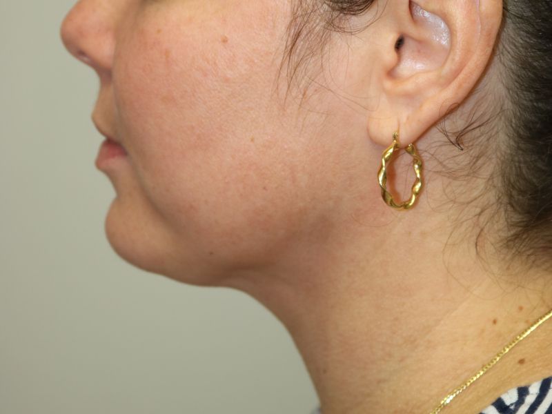 Neck Liposuction Before & After
