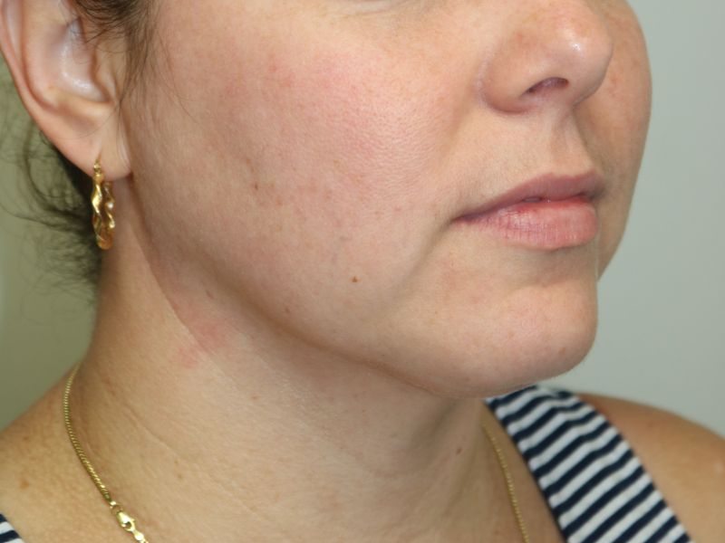 Neck Liposuction Before & After