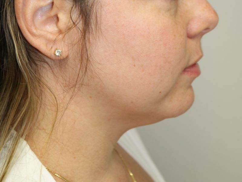 Neck Liposuction Before & After