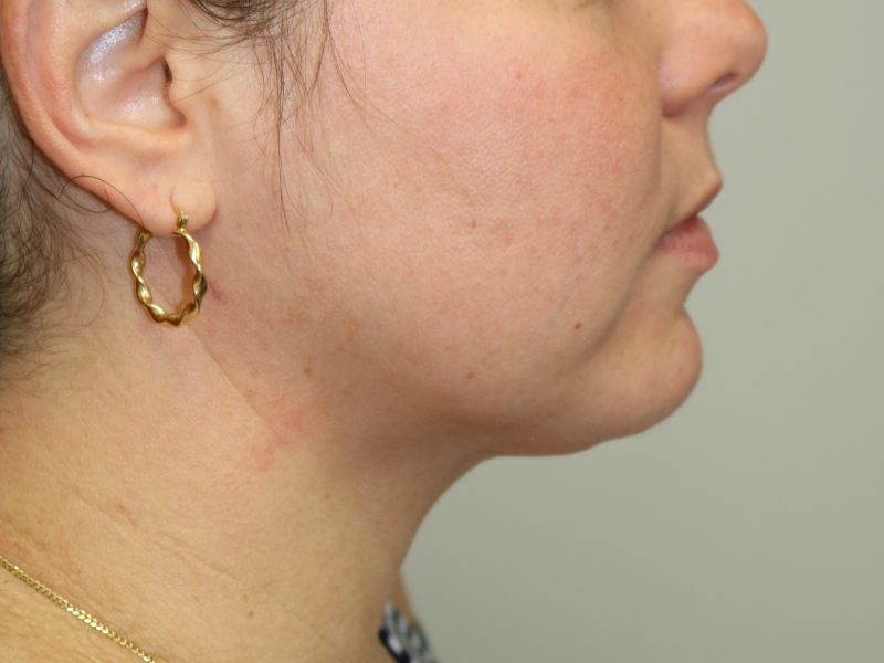 Neck Liposuction Before & After