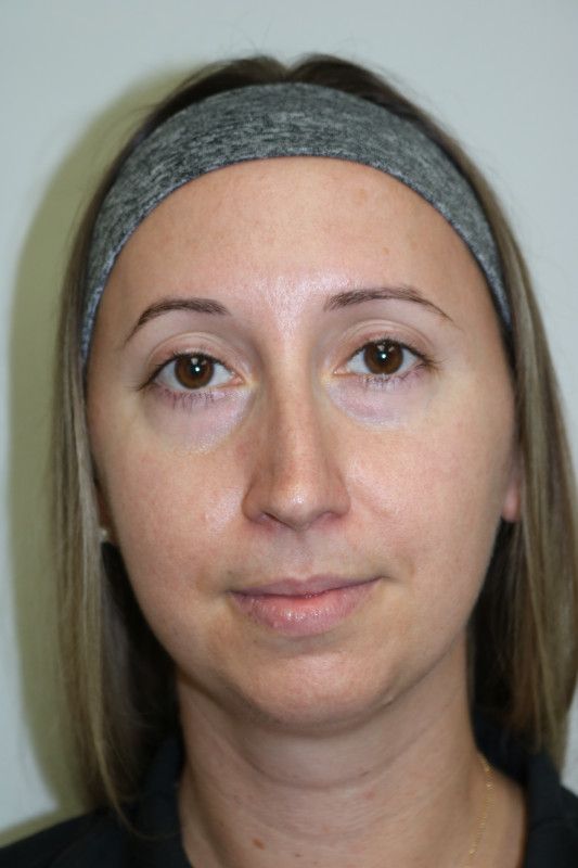 Neck Liposuction Before & After