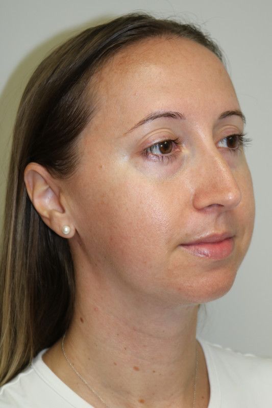 Neck Liposuction Before & After
