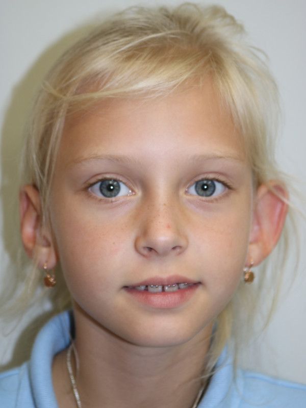 Otoplasty Before & After