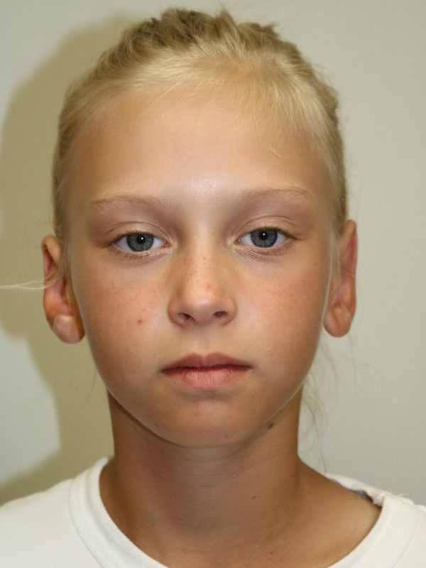 Otoplasty Before & After