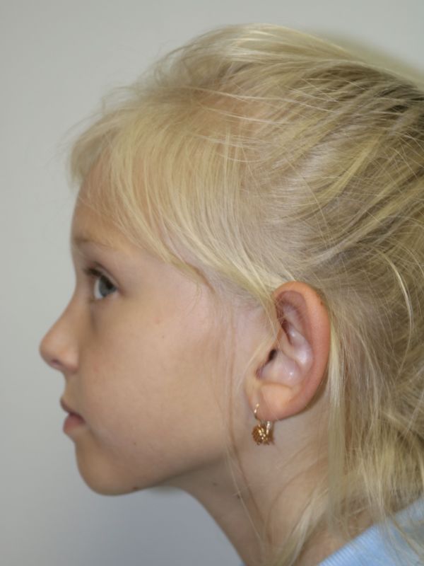 Otoplasty Before & After