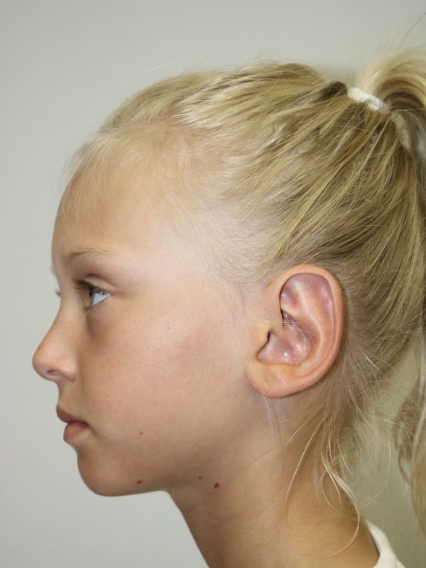 Otoplasty Before & After