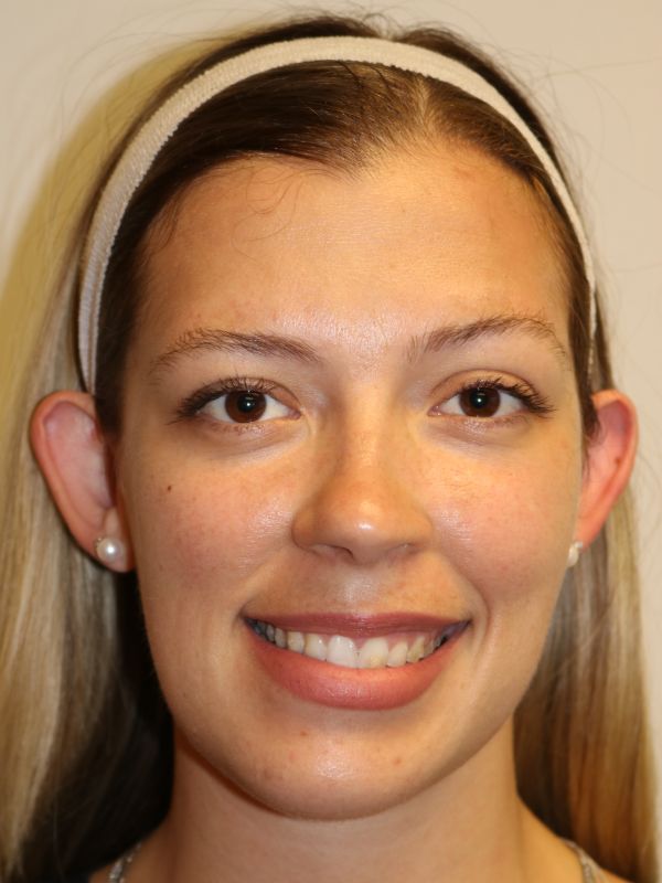 Otoplasty Before & After
