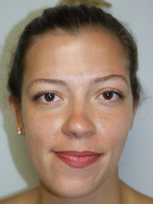 Otoplasty Before & After