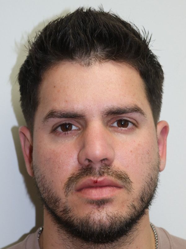Otoplasty Before & After