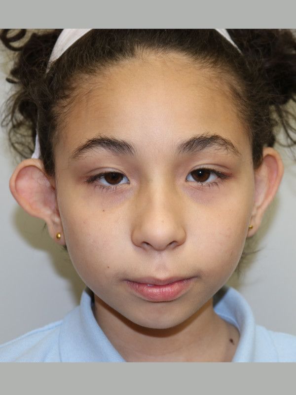 Otoplasty Before & After