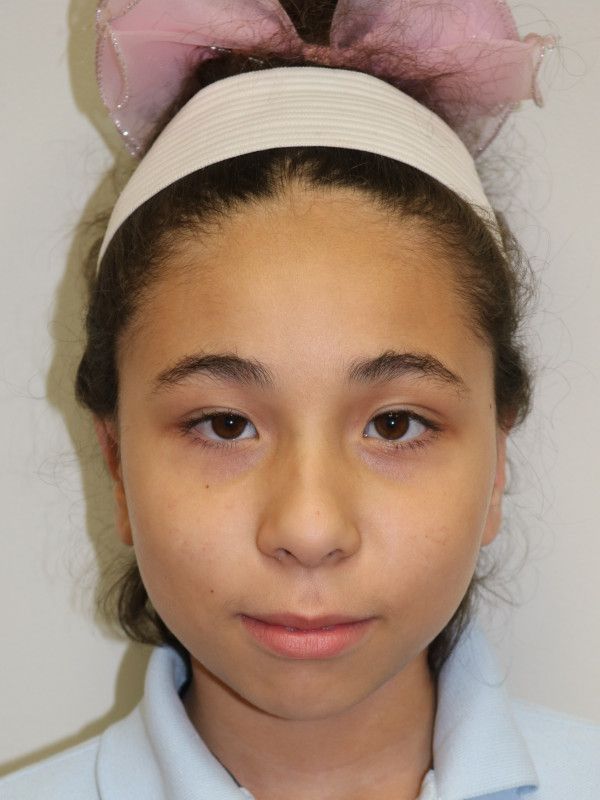 Otoplasty Before & After